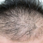 抗うつ薬SSRIの副作用による薄毛・抜け毛対策