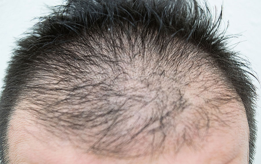 抗うつ薬SSRIの副作用による薄毛・抜け毛対策