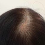 うつ病の薬の副作用で抜け毛・薄毛になる可能性